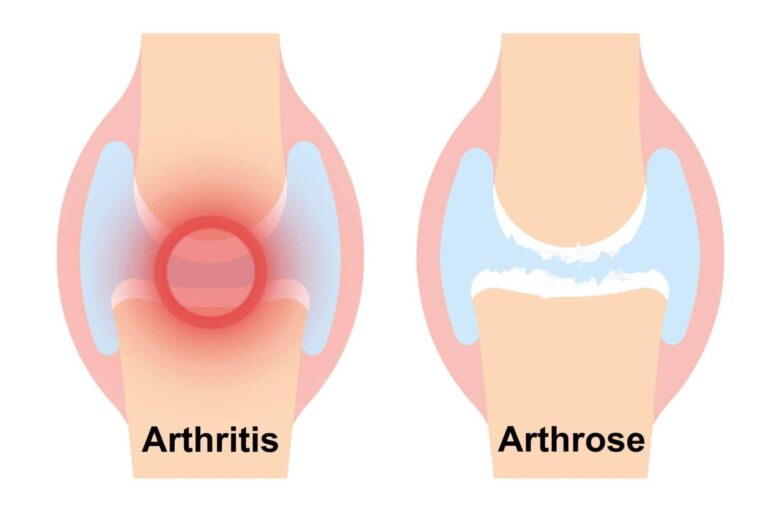 artrose vs artritis